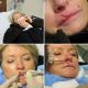 Martha Stewart has her lip stitched up after an altercation with her beloved dog Francesca, Jan. 2011